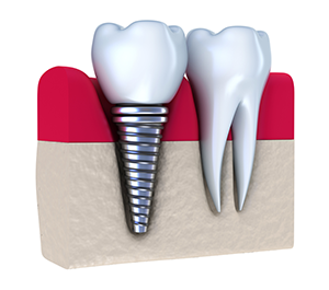 Dental Implants | Dentist in Fresno, CA | Professional Dental Care