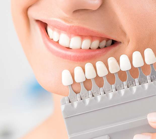 Fresno Veneers