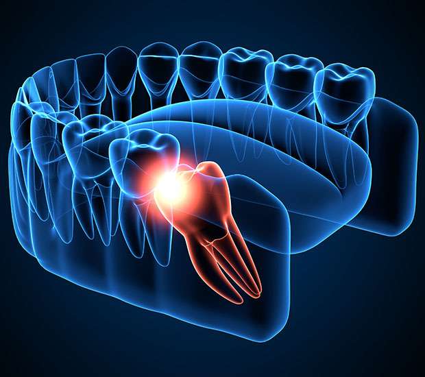 Wisdom Teeth Extraction Fresno, CA